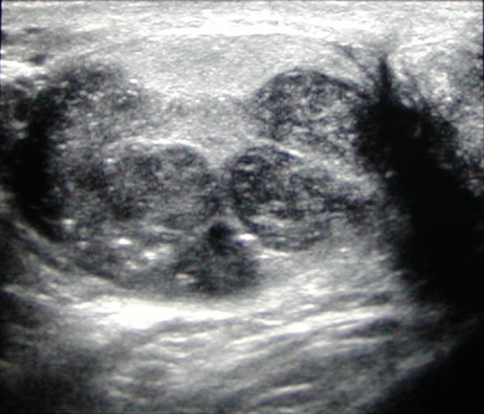 Ultrasound Of Testicles