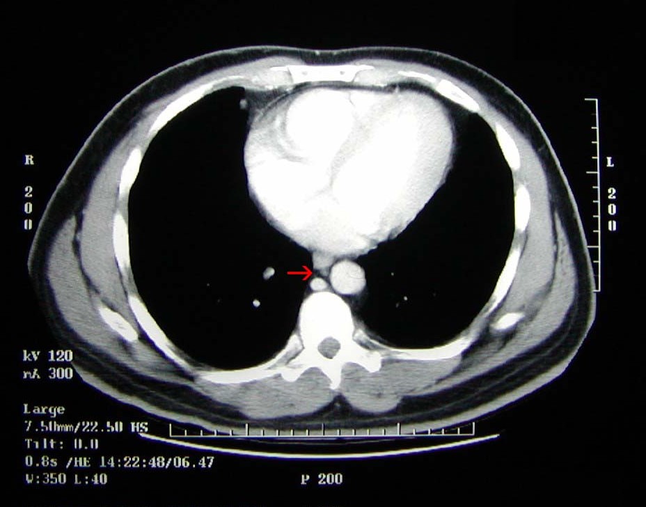 Cat Scan Heart